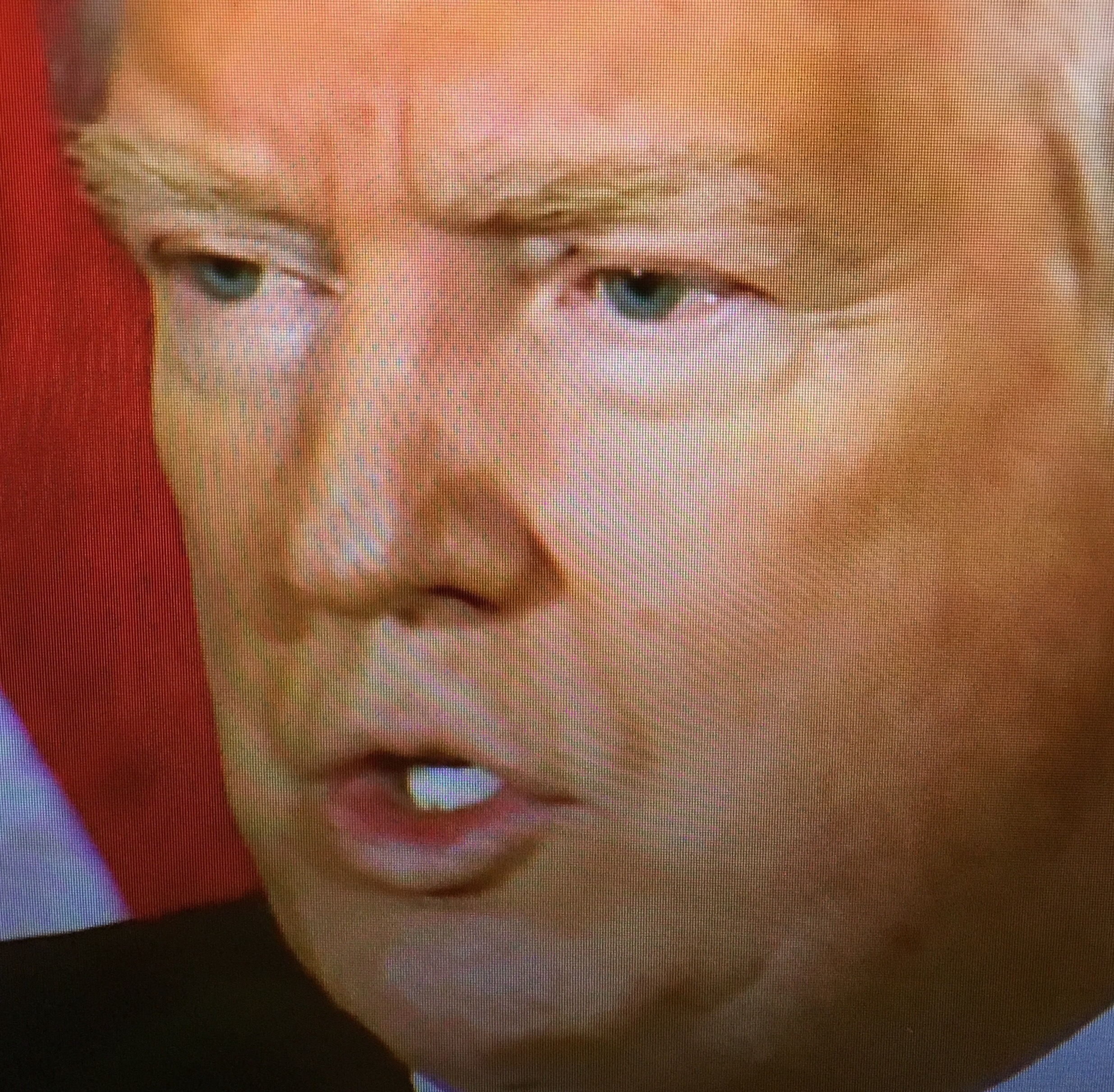 トランプ大統領の目の周りが白いのはなぜ 日焼け 白斑が原因